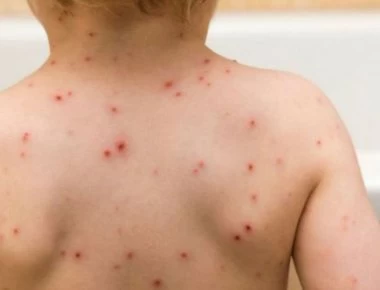 Η ιλαρά επιστρέφει και σκοτώνει 136.000 ανθρώπους - «Θερίζει» στην Αφρική και σε μία ευρωπαϊκή χώρα